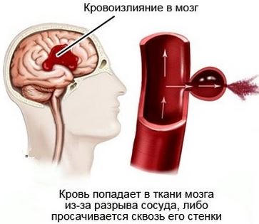 Разница между Кровоизлиянием в мозг и Инсультом 3 Геморрагический инсульт