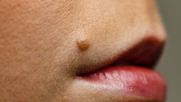 mole on face