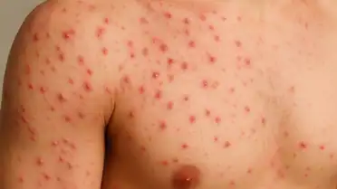 foliculite no corpo