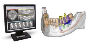 guided-implant-surgery