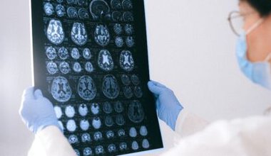 Deneysel ilaç lecanemab, üçüncü aşama klinik denemelerinde Alzheimer hastalığının tedavisinde