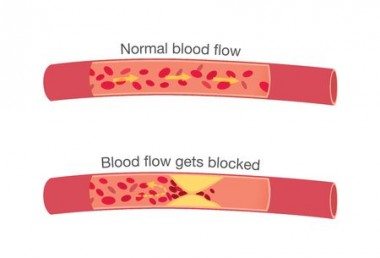 Angina Pectoris - What Is Angina and How Do We Deal With It?