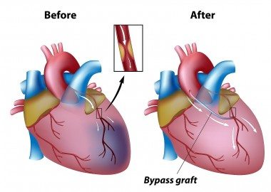 Angina Pectoris - What Is Angina and How Do We Deal With It?