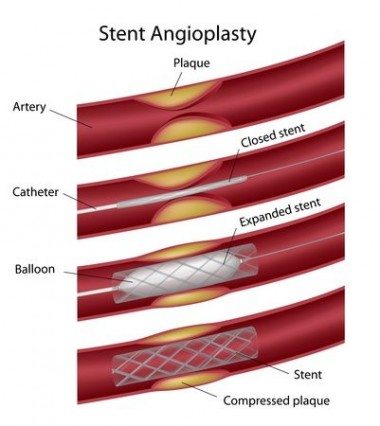 Angina Pectoris - What Is Angina and How Do We Deal With It?