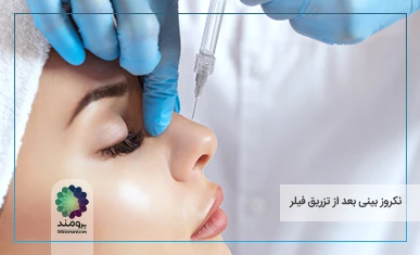 تصویر شاخص نکروز بینی بعد از تزریق فیلر