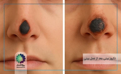 تصویر شاخص نکروز بینی بعد از عمل بینی