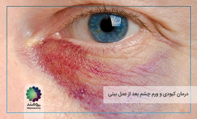 درمان قطعی کبودی و ورم چشم بعد از عمل بینی تصویر شاخص