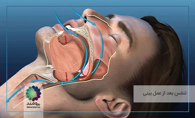 آیا عمل جراحی بینی در کاهش خر و پف مؤثر است