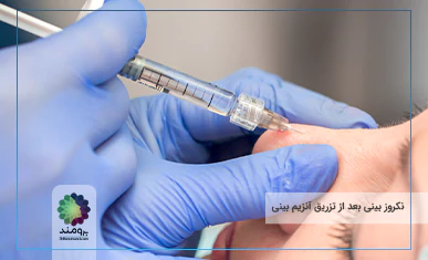 نکروز بینی بعد از تزریق آنزیم بینی تصویر شاخص