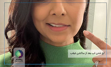 کج شدن لب بعد از ساکشن غبغب تصویر شاخص