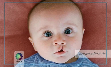 علت لب شکری شدن جنین تصویر شاخص