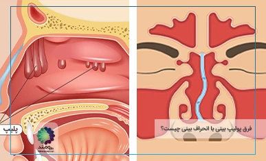 فرق پولیپ بینی با انحراف بینی تصویر شاخص
