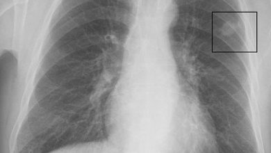 أسباب سرطان الرئة