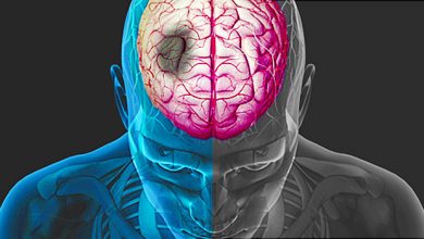 السكتة الدماغية