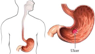 كل شيء عن قرحة المعدة