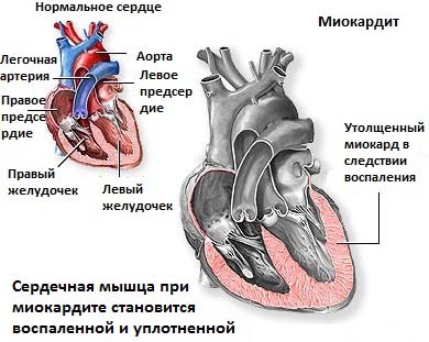 Разница между Миокардитом и Перикардитом 2 Миокардит