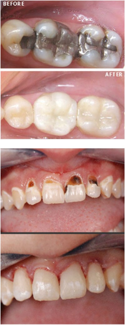 remove-amalgam-fillings Replacing Amalgam fillings