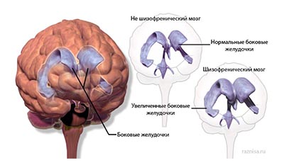 Разница между Шизофренией и Болезнью Альцгеймера