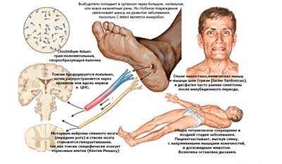 Разница между Тетанией и Столбняком