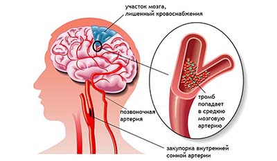 Разница между Кровоизлиянием в мозг и Инсультом
