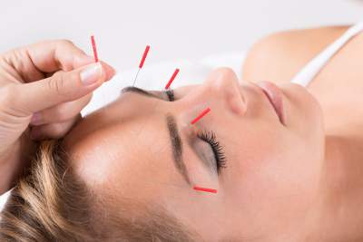 acupuncture for migraine prevention