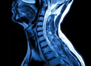 An x-ray of the Cervical spine 