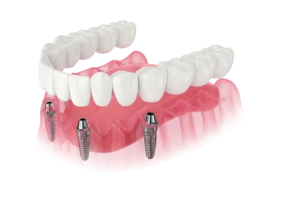 Dentures & Implants 4