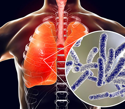 Legionella within the lungs