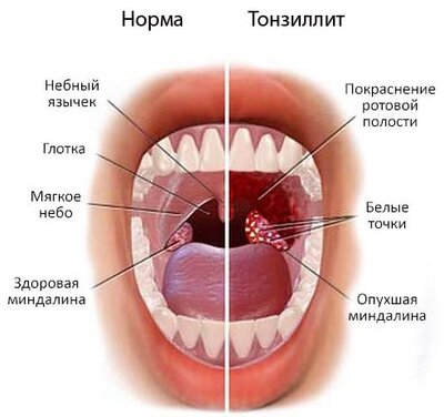 Разница между Фарингитом и Тонзиллитом 2 Тонзиллит