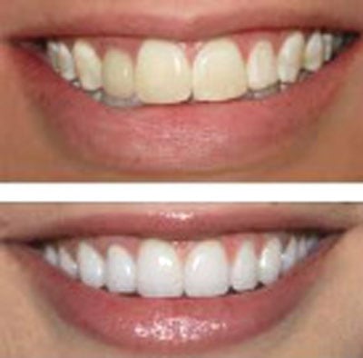 tooth-whitening-services Tooth-Whitening-Services