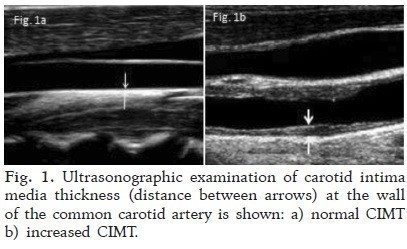 Carotid Intima-Media Thickness