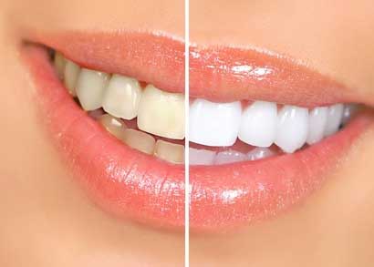 Professional teeth whitening at Frangella Dental NYC