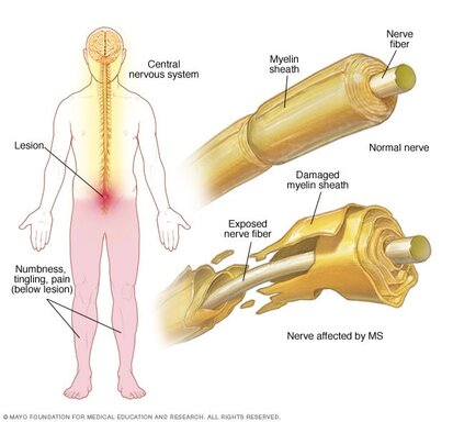 mcdc7_multiple_sclerosis_myelin_damage_nervous_system-8col