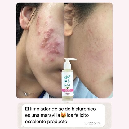 Jabón Facial con Ácido Hialuronico - Imagen 2