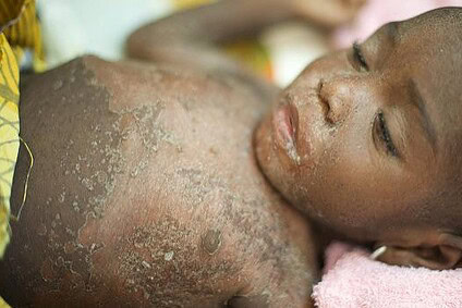 Sud-Kivu : plus de 8 000 cas de rougeole, urgence de vaccination