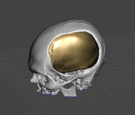 Reconstrução Craniana em 3D