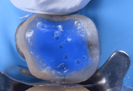 Sellado Dentinario Inmediato – Práctica Demostrativa