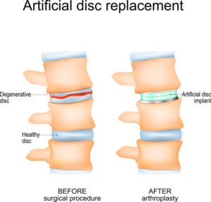 Diagram of an artificial disc replacement within the spine