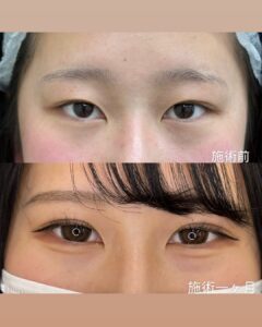 二重整形埋没法