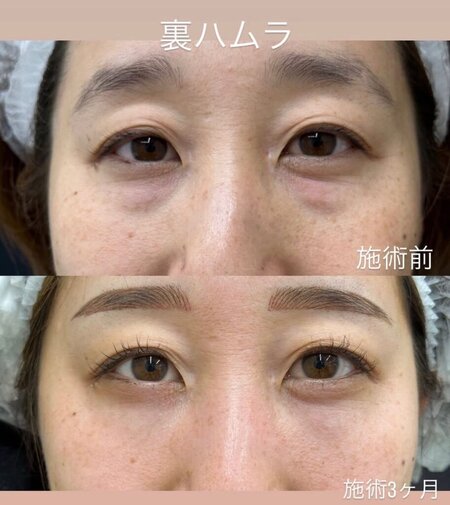 裏ハムラ法