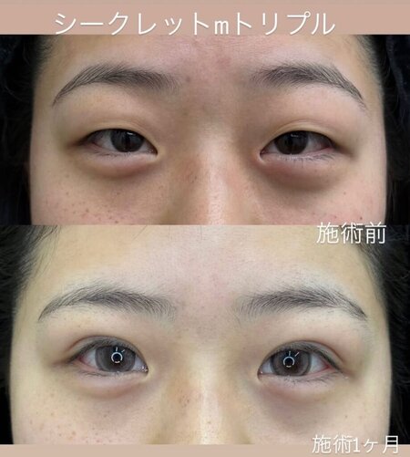 埋没法症例