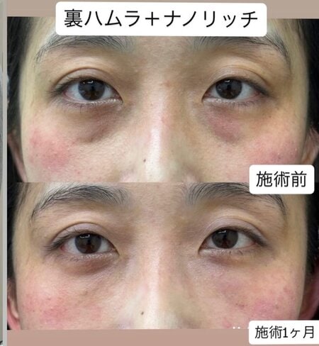 裏ハムラ法＋ナノリッチ