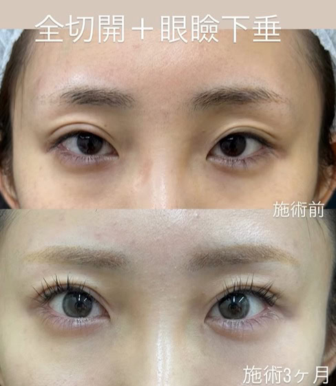 全切開
