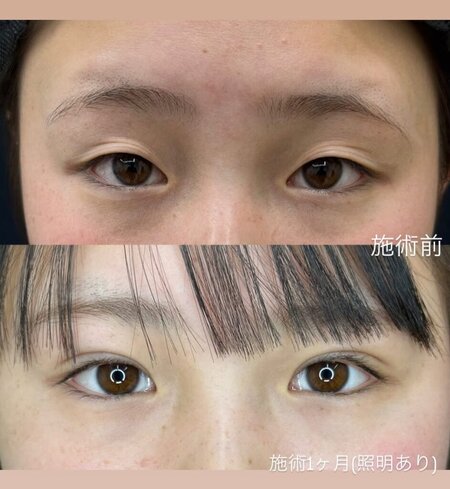 埋没法症例