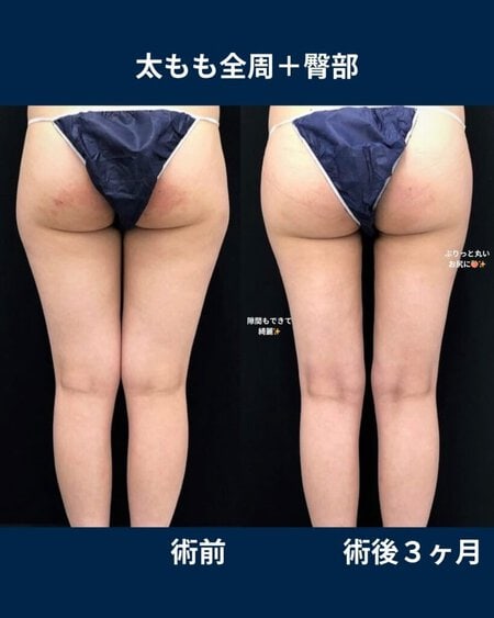 太もも＆臀部脂肪吸引