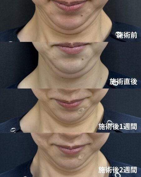脂肪溶解注射症例