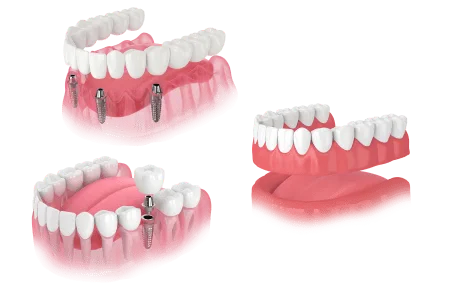 Dentures & Implants 1
