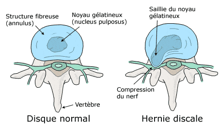 Schéma d'une vertèbre présentant un disque intervertébral sain et d'une hernie discale