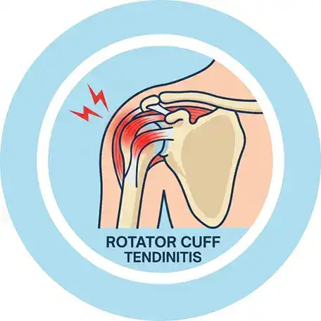 While tendinitis involves acute inflammation, tendinosis is a chronic, degenerative condition. It represents a breakdown of collagen fibers within the rotator cuff tendons over time, typically due to repetitive micro-wear without adequate healing.It is treated by therapeutic massage therapy at Prairie Osteopath Medical Clinic in Regina SK