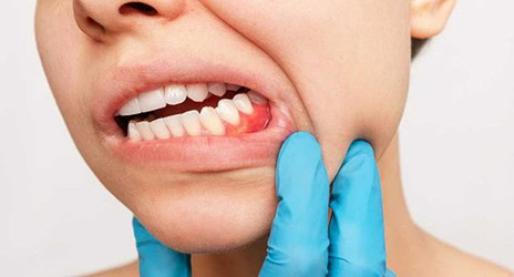 Consecuencias del cepillado agresivo